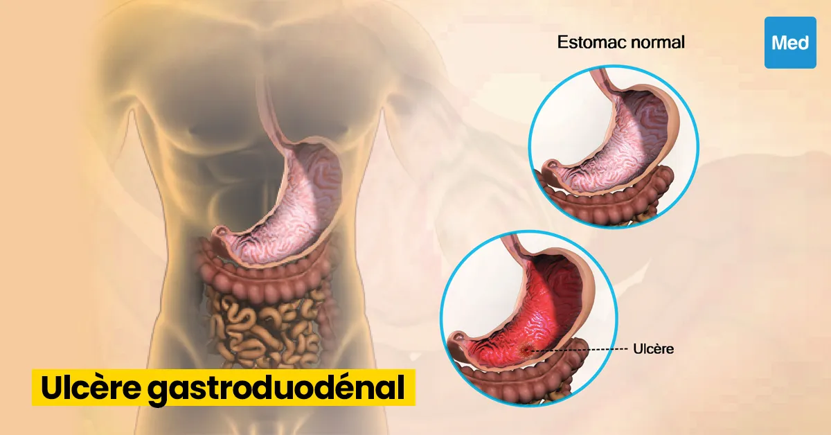 L'ulcère gastroduodénal : une maladie fréquente et traitable